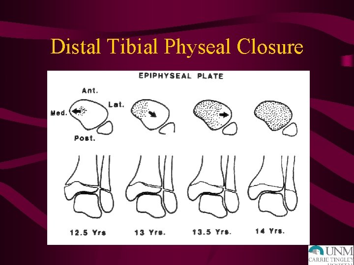 Distal Tibial Physeal Closure 