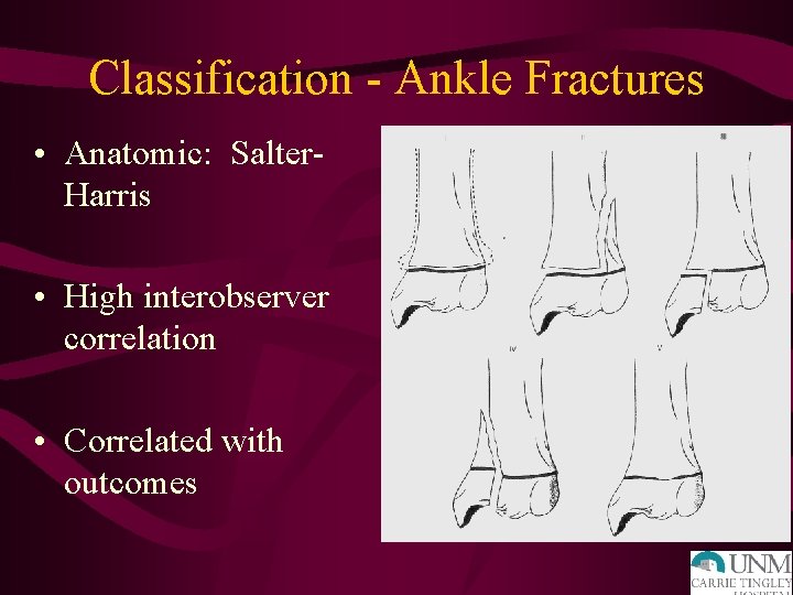 Classification - Ankle Fractures • Anatomic: Salter. Harris • High interobserver correlation • Correlated