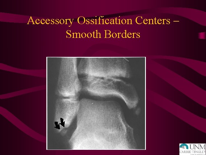 Accessory Ossification Centers – Smooth Borders 