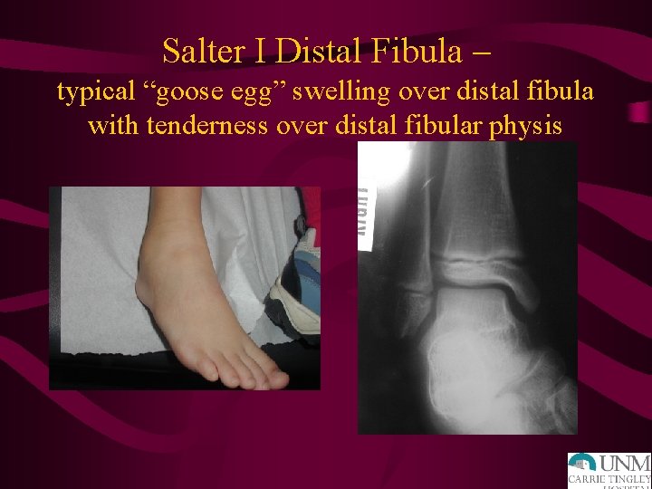 Salter I Distal Fibula – typical “goose egg” swelling over distal fibula with tenderness