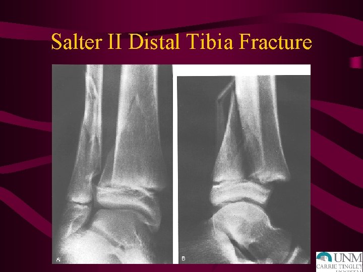 Salter II Distal Tibia Fracture 