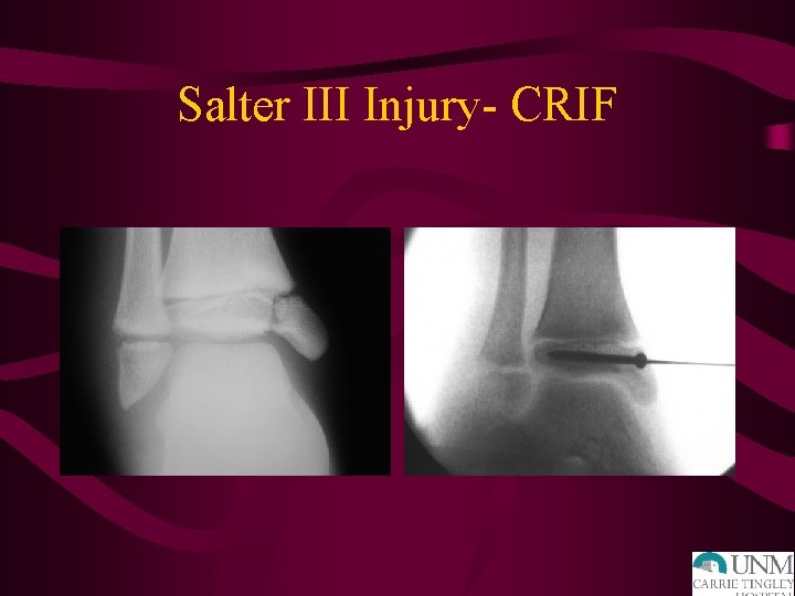 Salter III Injury- CRIF 