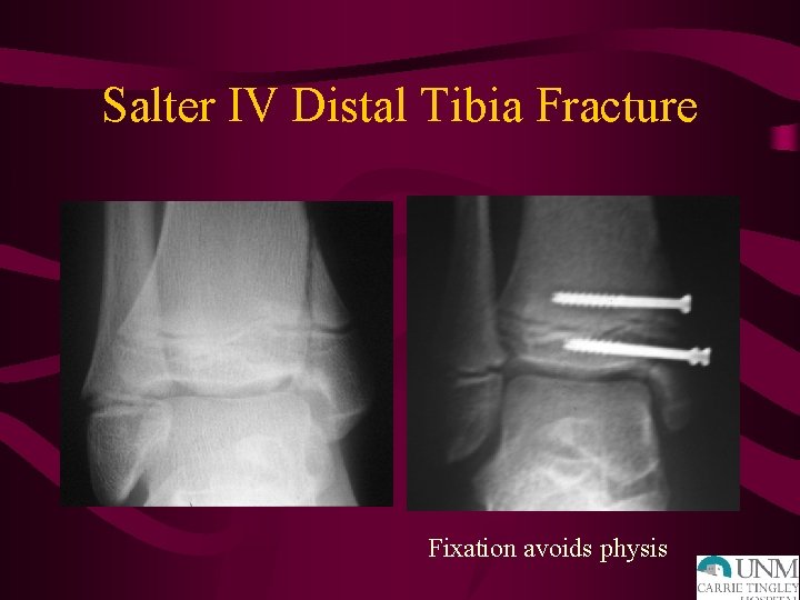 Salter IV Distal Tibia Fracture Fixation avoids physis 