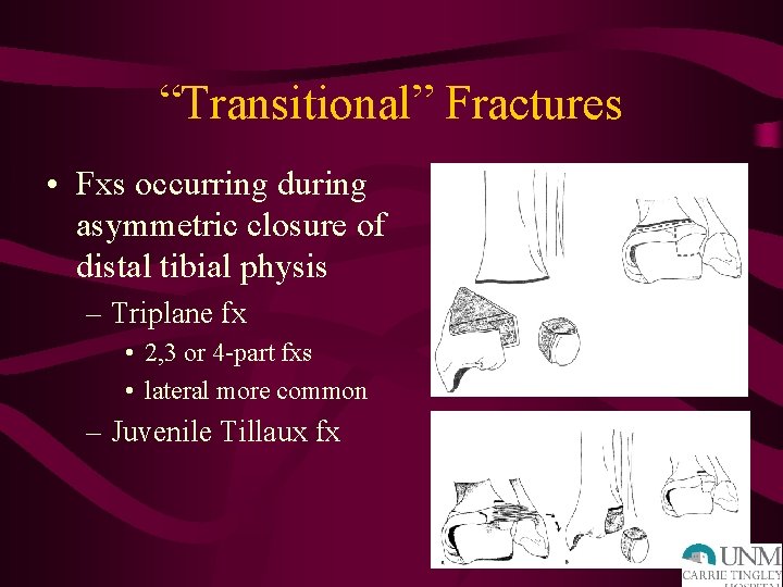 “Transitional” Fractures • Fxs occurring during asymmetric closure of distal tibial physis – Triplane