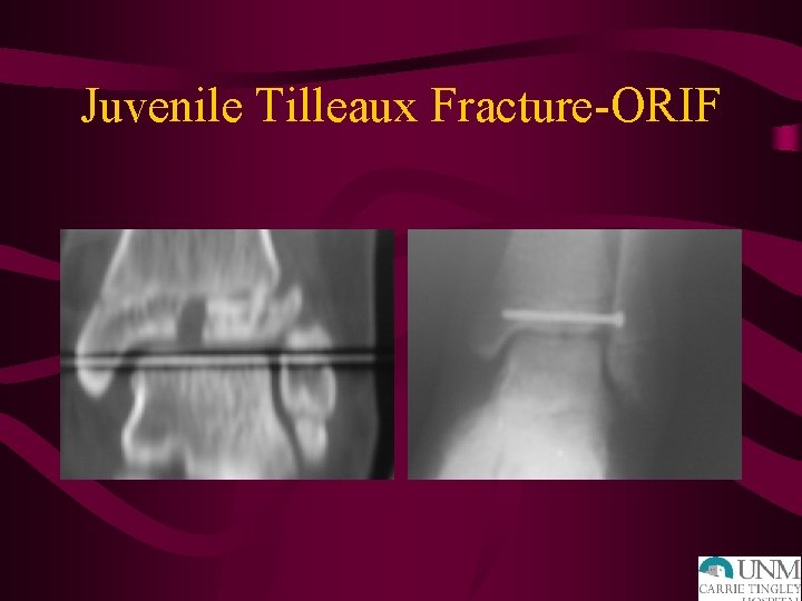 Juvenile Tilleaux Fracture-ORIF 