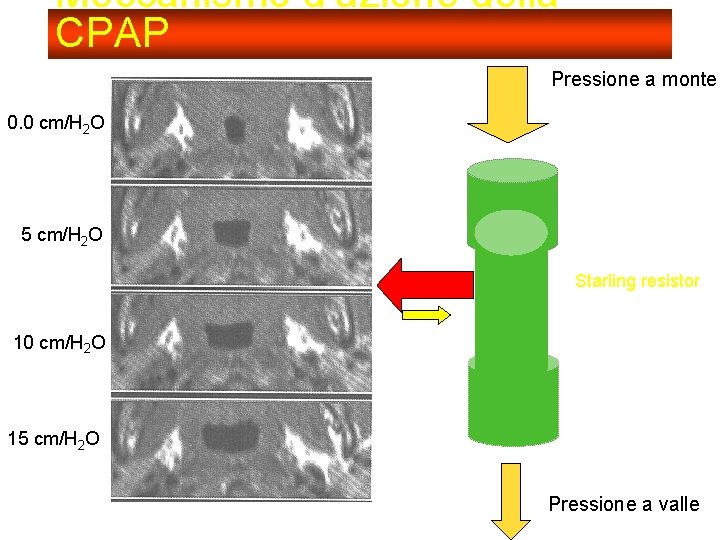 Meccanismo d’azione della CPAP Pressione a monte 0. 0 cm/H 2 O 5 cm/H