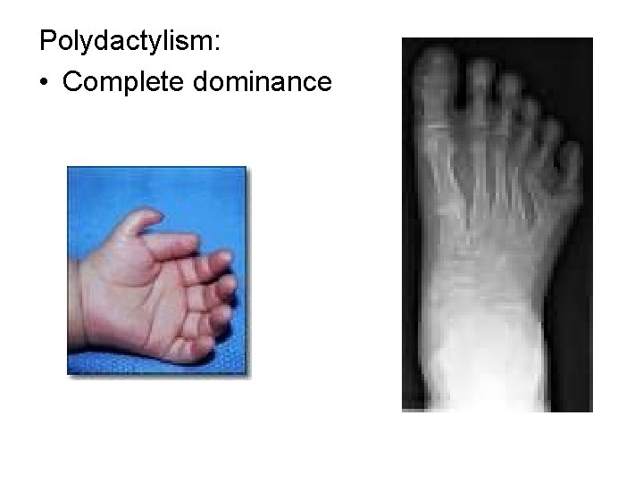 Polydactylism: • Complete dominance 
