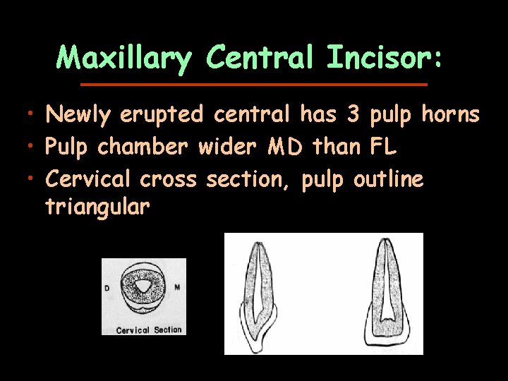 Maxillary Central Incisor: • Newly erupted central has 3 pulp horns • Pulp chamber