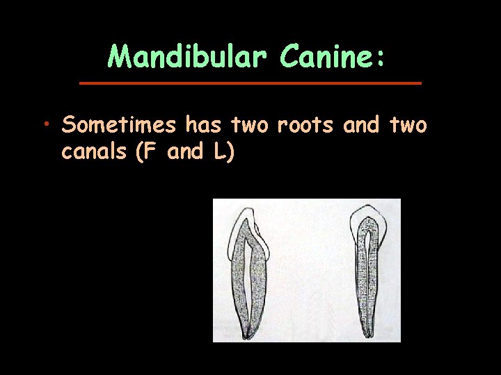 Mandibular Canine: • Sometimes has two roots and two canals (F and L) 