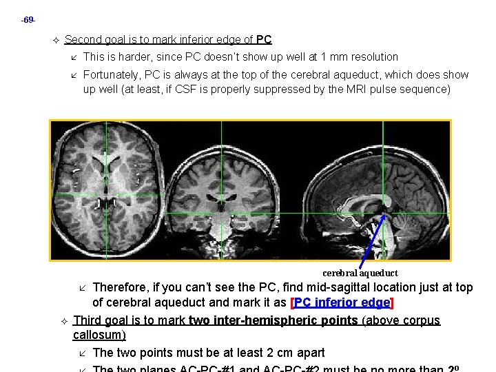 -69 Second goal is to mark inferior edge of PC This is harder, since