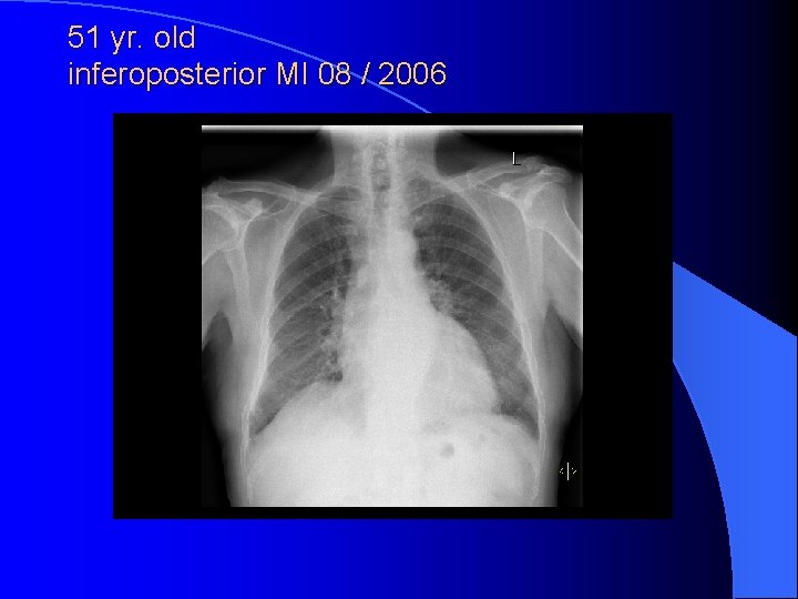 51 yr. old inferoposterior MI 08 / 2006 