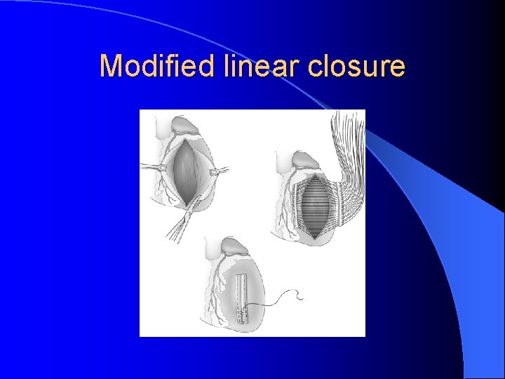 Modified linear closure 