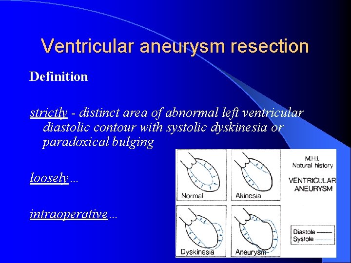 Ventricular aneurysm resection Definition strictly - distinct area of abnormal left ventricular diastolic contour