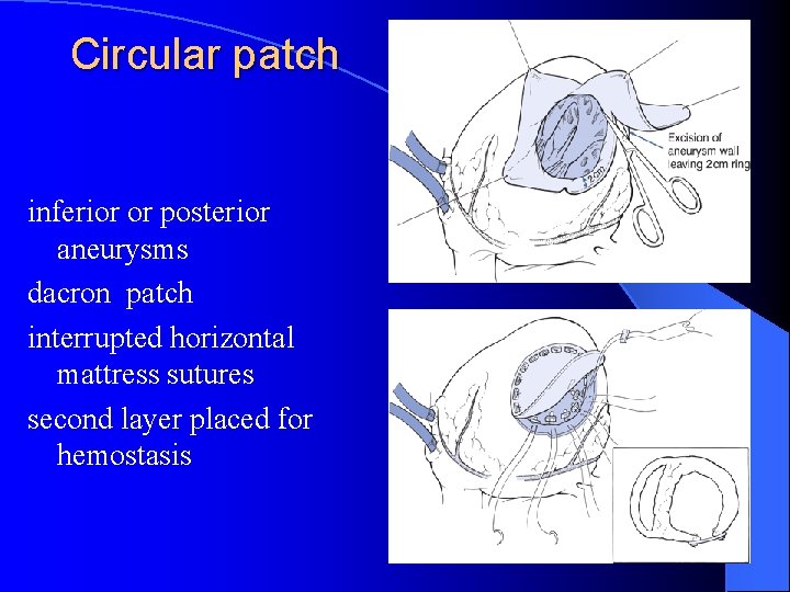 Circular patch inferior or posterior aneurysms dacron patch interrupted horizontal mattress sutures second layer
