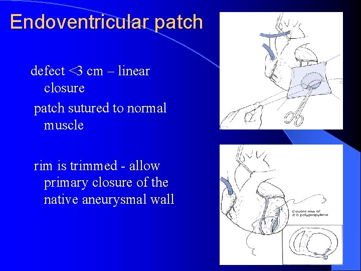 Endoventricular patch defect <3 cm – linear closure patch sutured to normal muscle rim