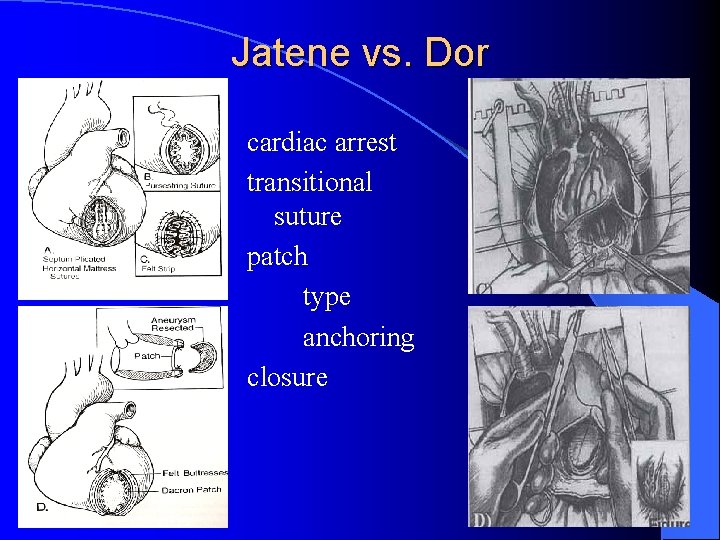 Jatene vs. Dor cardiac arrest transitional suture patch type anchoring closure 
