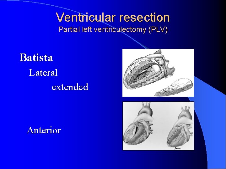 Ventricular resection Partial left ventriculectomy (PLV) Batista Lateral extended Anterior 