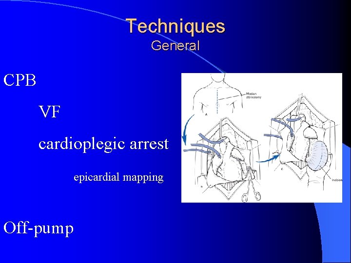 Techniques General CPB VF cardioplegic arrest epicardial mapping Off-pump 