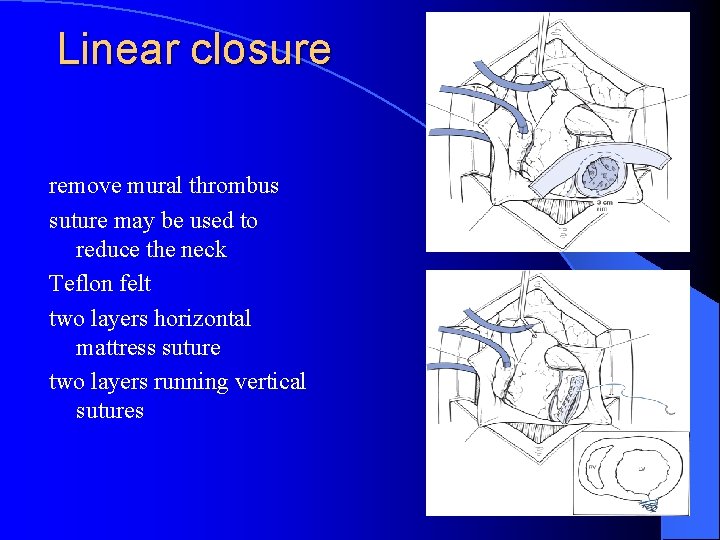 Linear closure remove mural thrombus suture may be used to reduce the neck Teflon