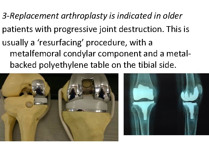 3 -Replacement arthroplasty is indicated in older patients with progressive joint destruction. This is