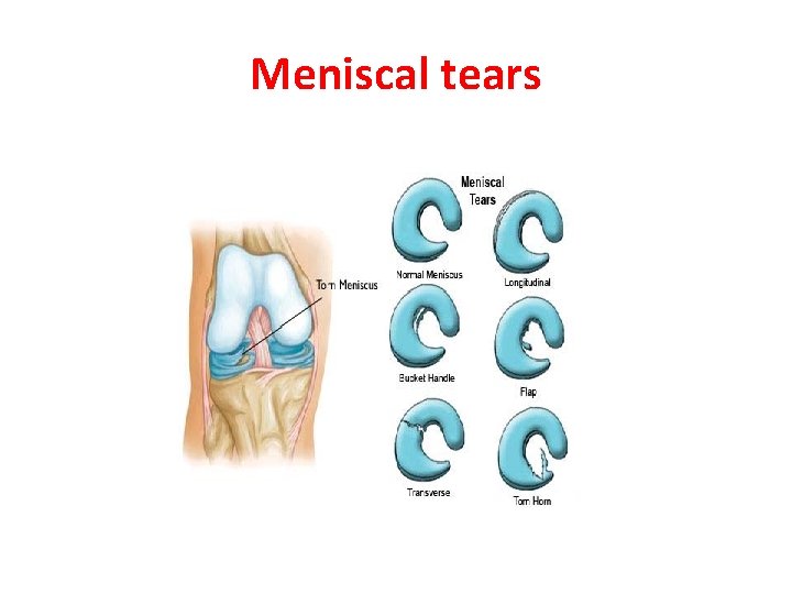 Meniscal tears 