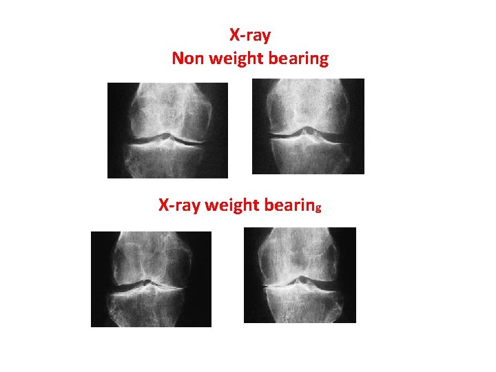 X-ray Non weight bearing X-ray weight bearing 