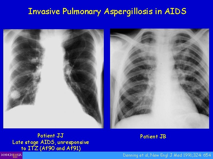 Invasive Pulmonary Aspergillosis in AIDS Patient JJ Late stage AIDS, unresponsive to ITZ (Af