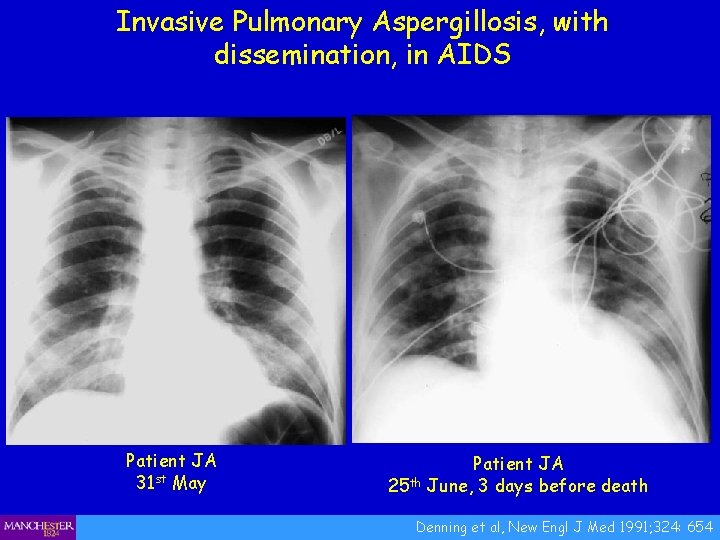 Invasive Pulmonary Aspergillosis, with dissemination, in AIDS Patient JA 31 st May Patient JA