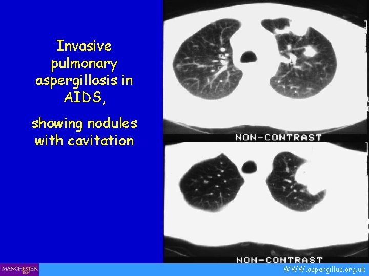 Invasive pulmonary aspergillosis in AIDS, showing nodules with cavitation WWW. aspergillus. org. uk 