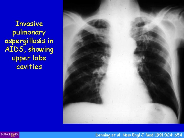 Invasive pulmonary aspergillosis in AIDS, showing upper lobe cavities Denning et al, New Engl