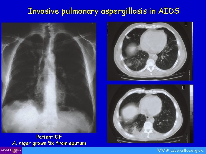 Invasive pulmonary aspergillosis in AIDS Patient DF A. niger grown 5 x from sputum