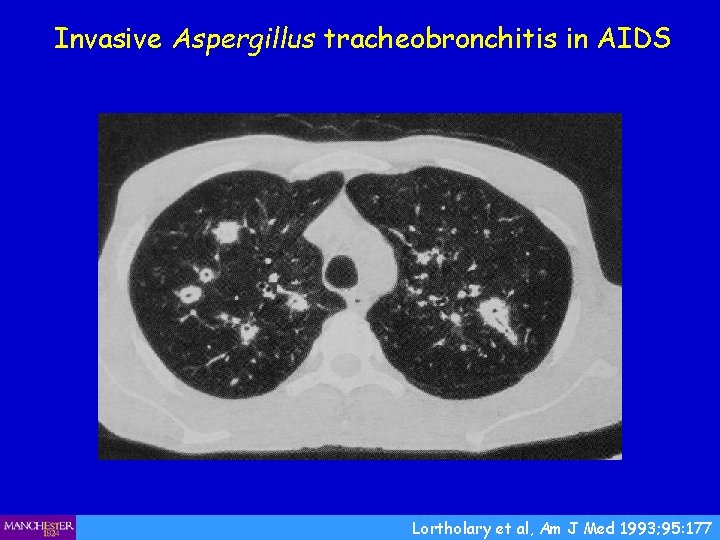 Invasive Aspergillus tracheobronchitis in AIDS Lortholary et al, Am J Med 1993; 95: 177