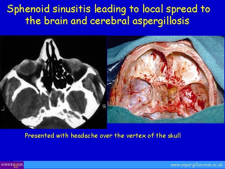 Sphenoid sinusitis leading to local spread to the brain and cerebral aspergillosis Presented with