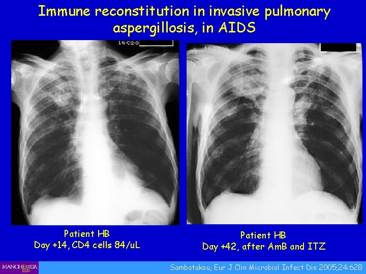 Immune reconstitution in invasive pulmonary aspergillosis, in AIDS Patient HB Day +14, CD 4
