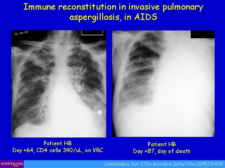Immune reconstitution in invasive pulmonary aspergillosis, in AIDS Patient HB Day +64, CD 4
