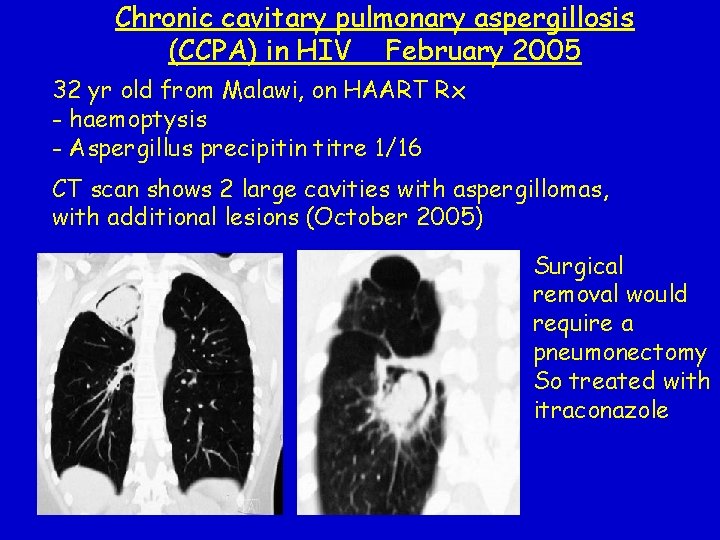 Chronic cavitary pulmonary aspergillosis (CCPA) in HIV February 2005 32 yr old from Malawi,