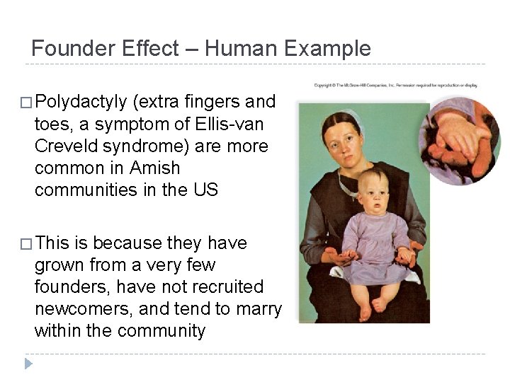 Founder Effect – Human Example � Polydactyly (extra fingers and toes, a symptom of