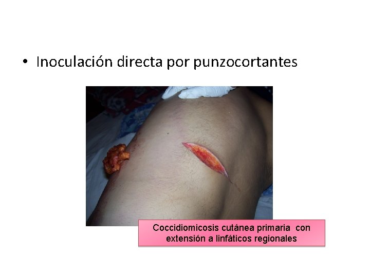  • Inoculación directa por punzocortantes Coccidiomicosis cutánea primaria con extensión a linfáticos regionales