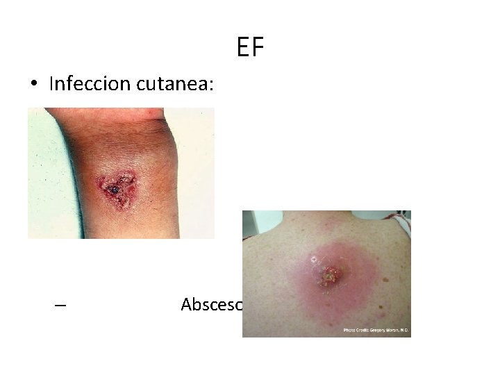 EF • Infeccion cutanea: – Abscesos 