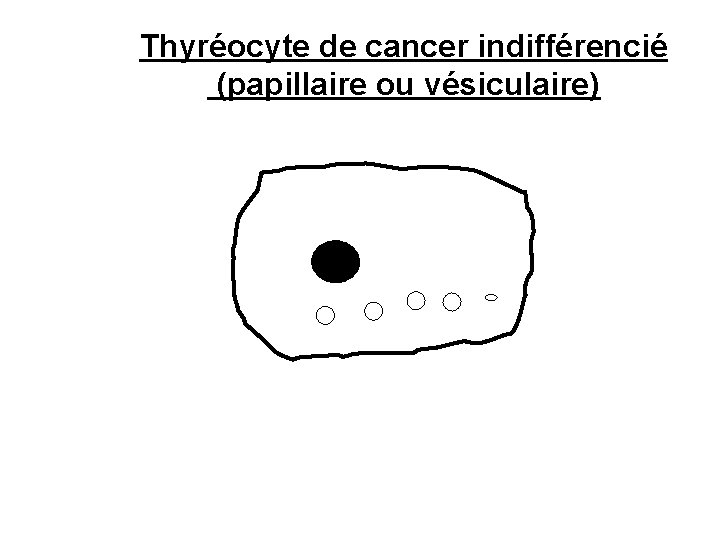 Thyréocyte de cancer indifférencié (papillaire ou vésiculaire) 