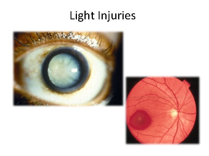 Light Injuries 