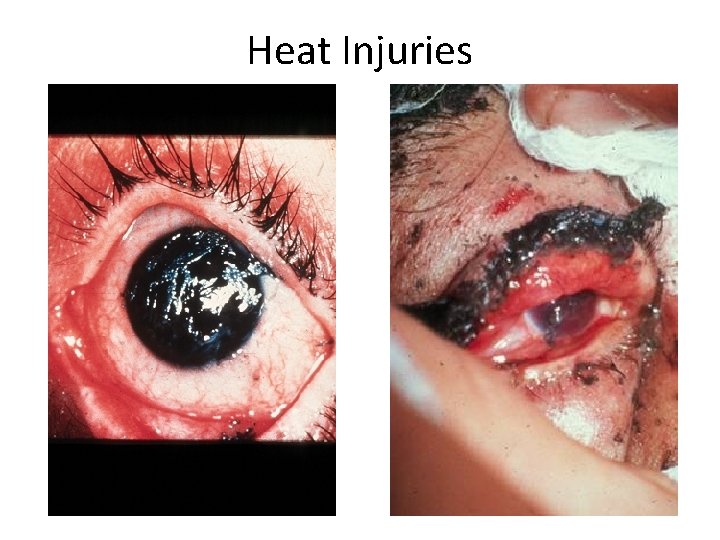 Heat Injuries 