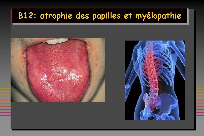 B 12: atrophie des papilles et myélopathie 