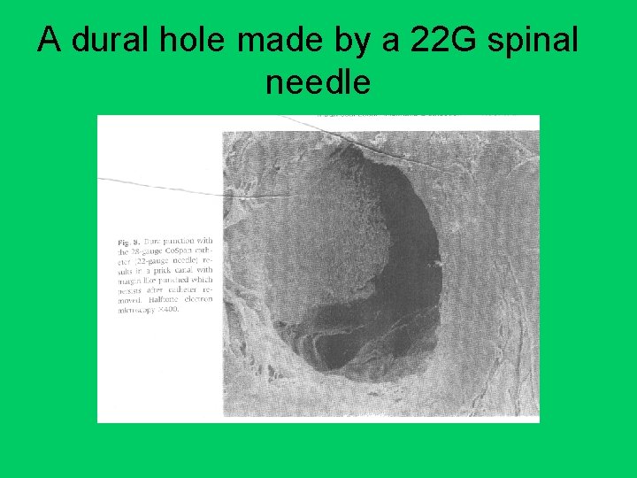 A dural hole made by a 22 G spinal needle 