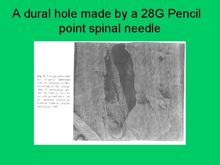 A dural hole made by a 28 G Pencil point spinal needle 