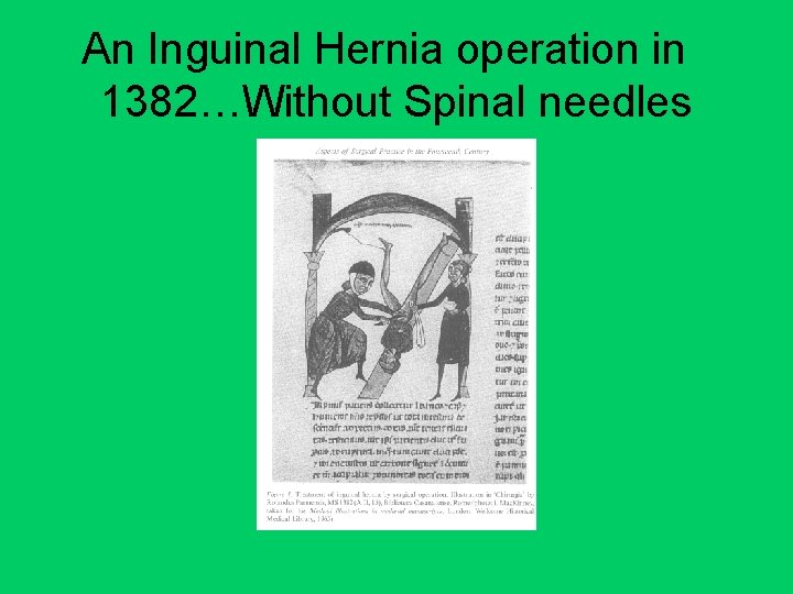 An Inguinal Hernia operation in 1382…Without Spinal needles 
