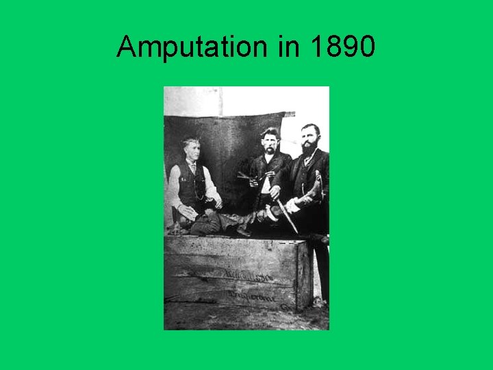 Amputation in 1890 
