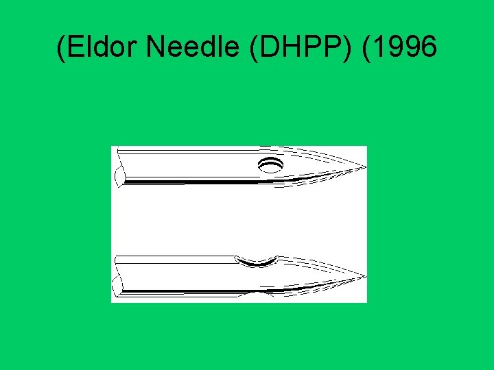 (Eldor Needle (DHPP) (1996 