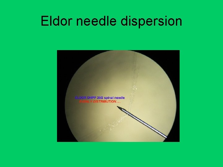 Eldor needle dispersion 