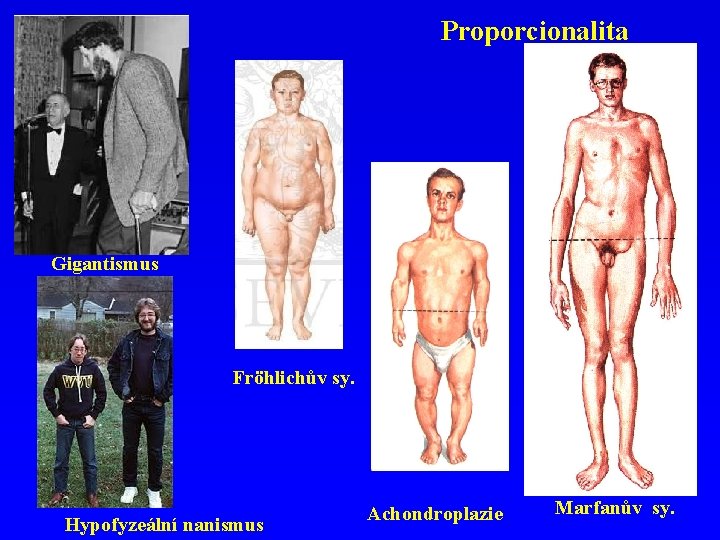 Proporcionalita Gigantismus Fröhlichův sy. Hypofyzeální nanismus Achondroplazie Marfanův sy. 